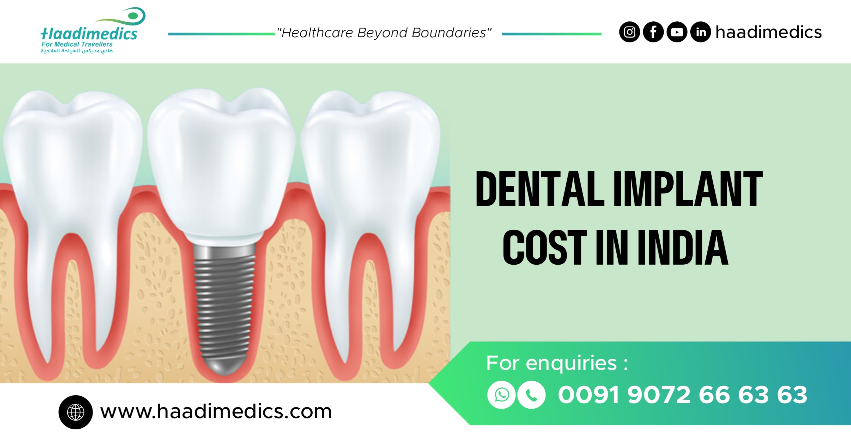 Dental Implant Cost in India