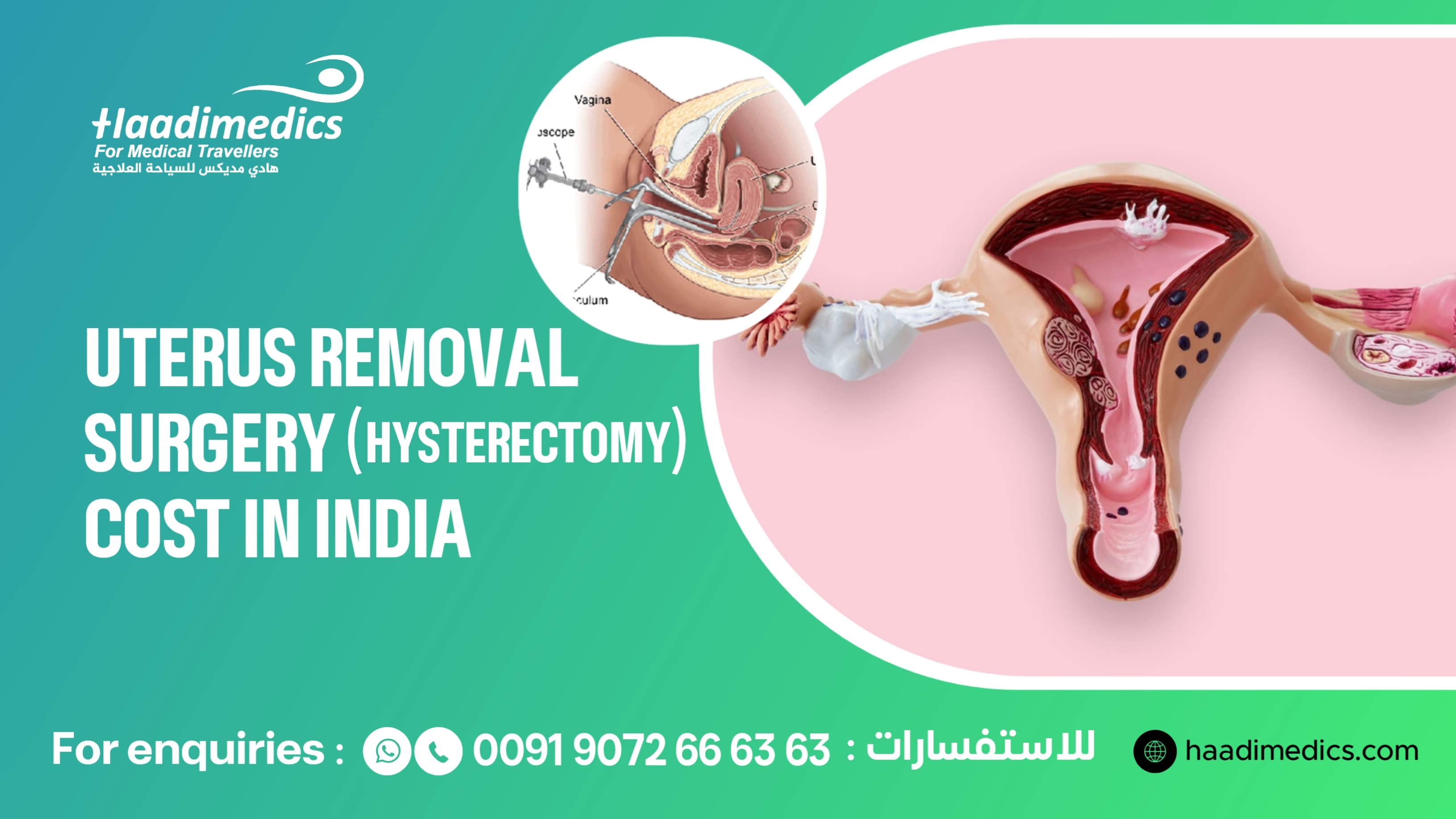 Uterus Removal Surgery (Hysterectomy)Cost in India