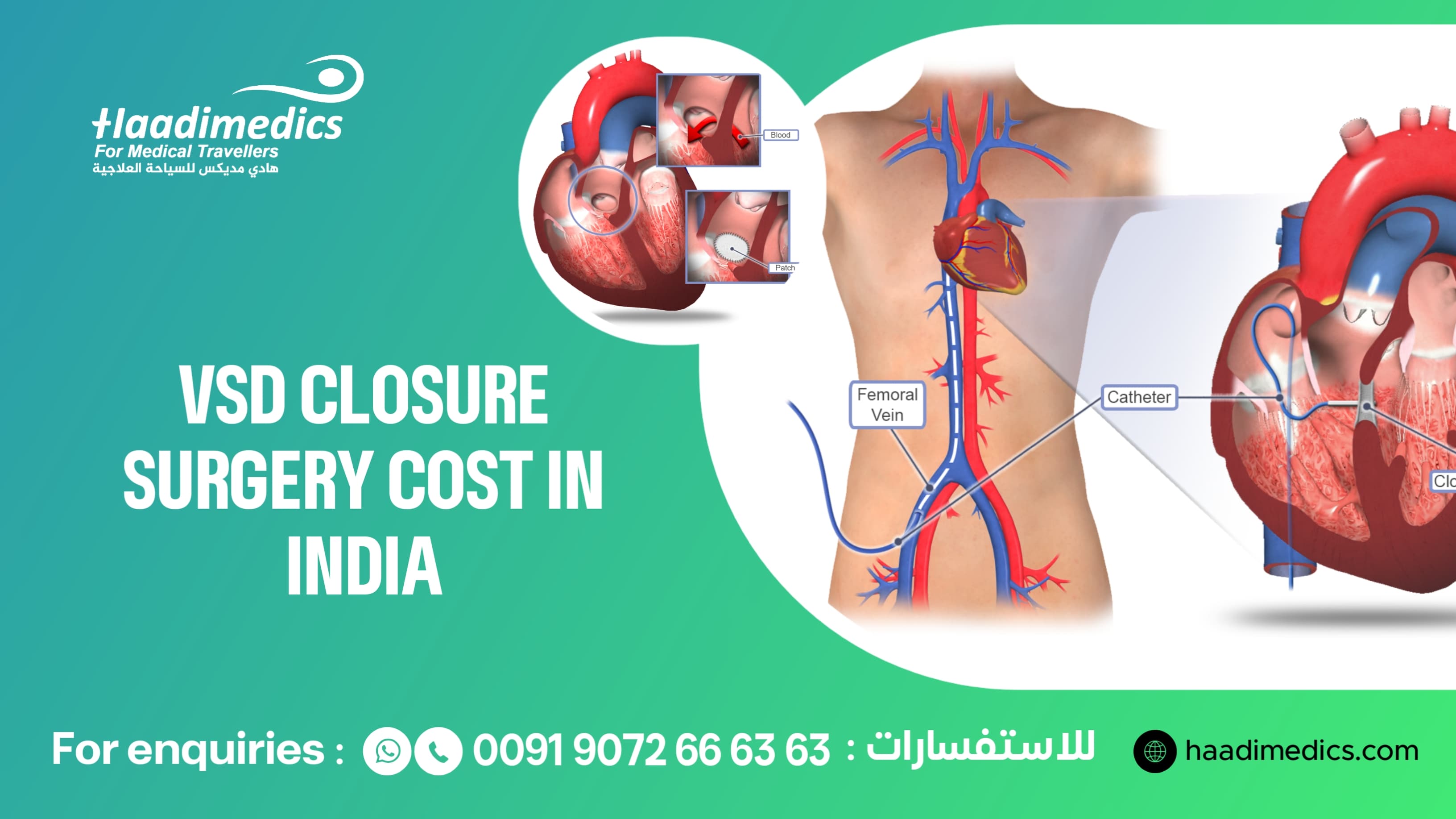 Ventricular Septal Defect (VSD) Surgery Cost in India