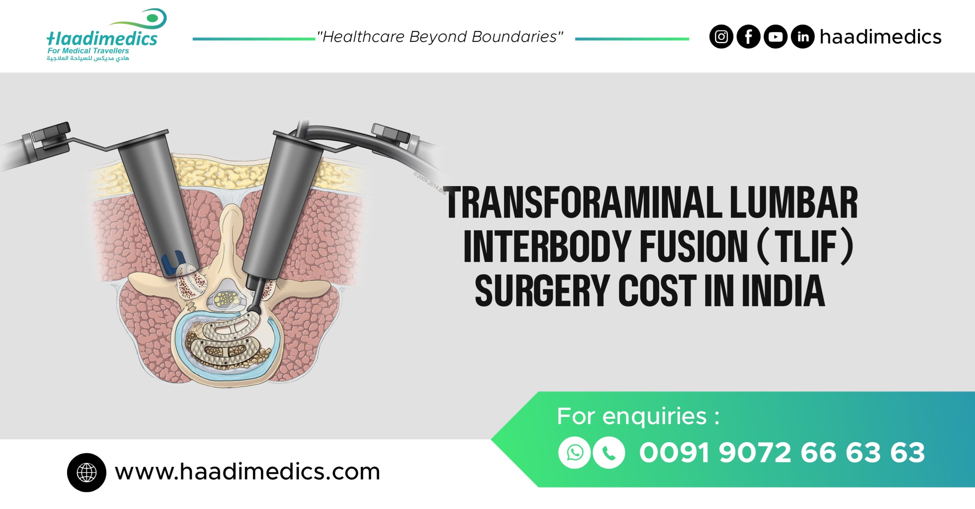 Transforaminal Lumbar Interbody Fusion ‘TLIF’ Surgery Cost in India