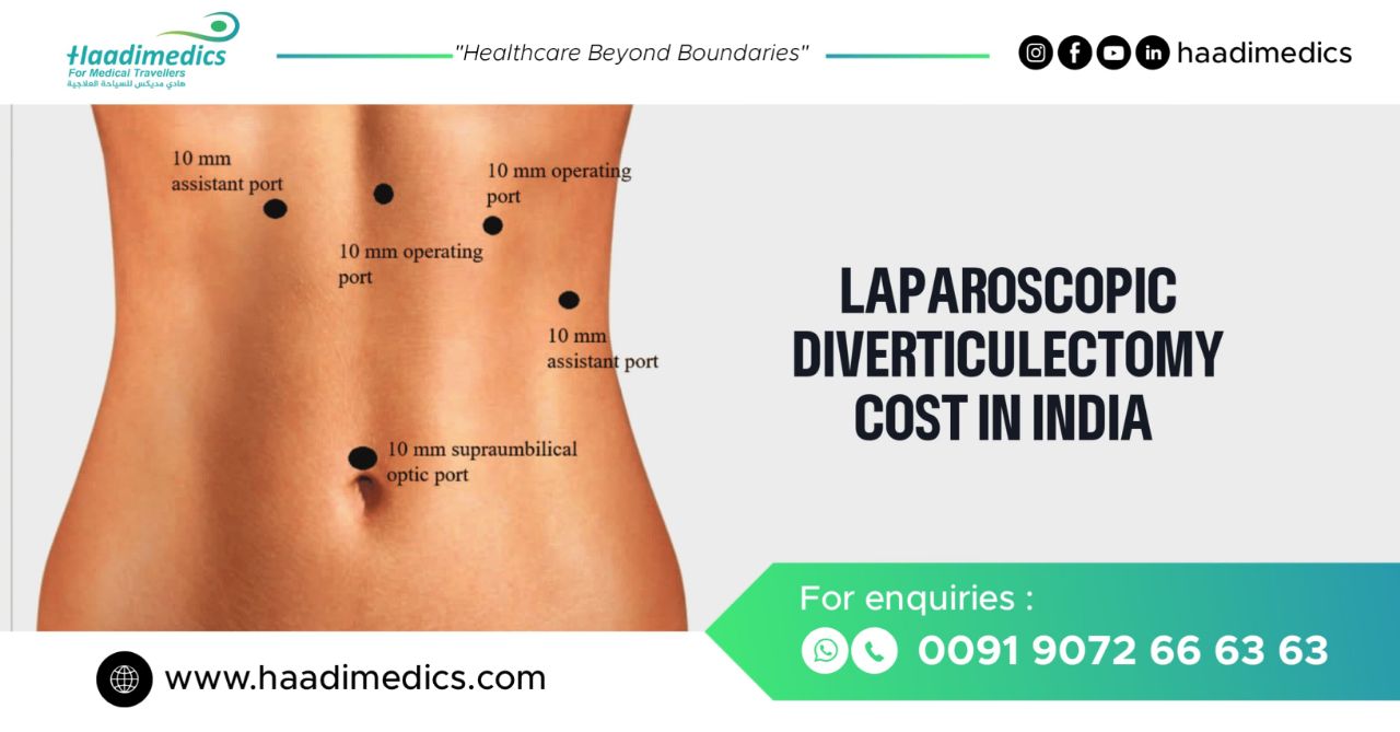 Laparoscopic Diverticulectomy Cost in India