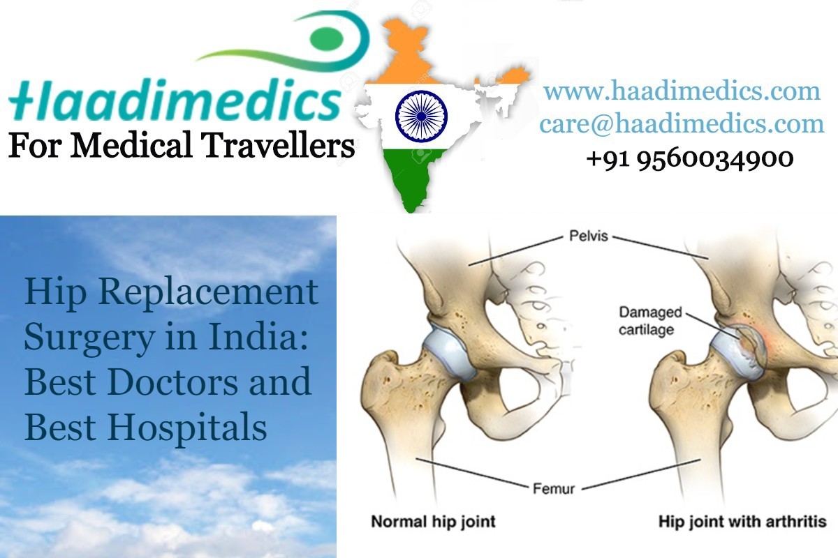 Hip Replacement Surgery in India: Best Doctors and Best Hospitals