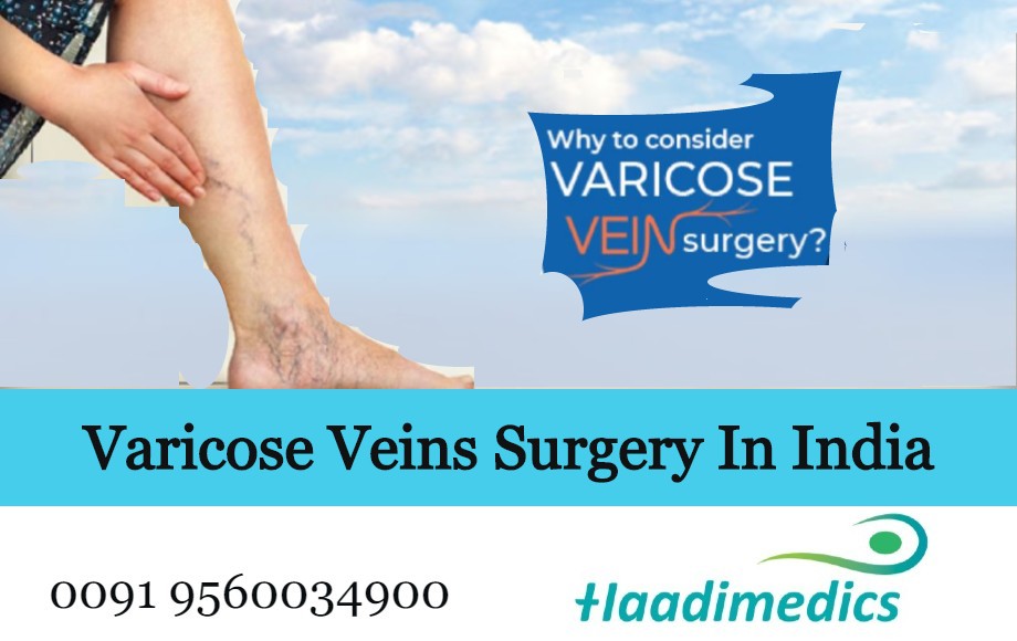 Varicose Veins Surgery in India